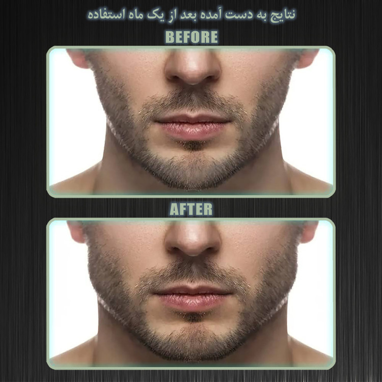 زاویه ساز فک رادیس فیت مدل Full Weight بسته شش عددی